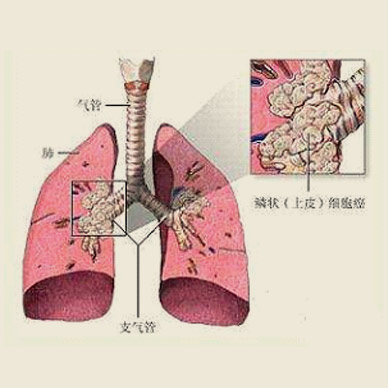 肺癌中医治疗方法