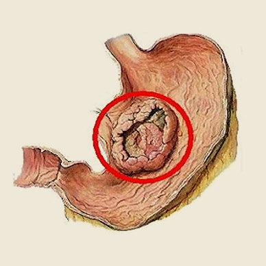 胃癌中医治疗方法